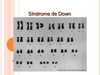 Síndrome de Down http://www.assis.unesp.br/egalhard/Numericas.htm 
