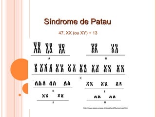 Síndrome de Patau 47, XX (ou XY) + 13 http://www.assis.unesp.br/egalhard/Numericas.htm 