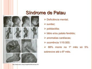 Síndrome de Patau Deficiência mental; surdez; polidactilia; lábio e/ou palato fendido; anomalias cardíacas; ocorrência 1/10.000; 88% morre no 1º mês só 5% sobrevive até o 6º mês. http://www.assis.unesp.br/egalhard/Numericas.htm 
