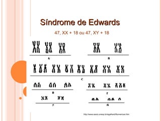 Síndrome de Edwards http://www.assis.unesp.br/egalhard/Numericas.htm 47, XX + 18 ou 47, XY + 18  
