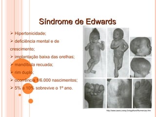 Síndrome de Edwards http://www.assis.unesp.br/egalhard/Numericas.htm Hipertonicidade;  deficiência mental e de crescimento; implantação baixa das orelhas;  mandíbula recuada;  rim duplo;  ocorrência 1/6.000 nascimentos;  5% a 10% sobrevive o 1º ano. 