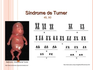 Síndrome de Turner http://www.assis.unesp.br/egalhard/Numericas.htm 45, X0 http://www.sindromes.org/sindromedeturner/ Natimorto - Síndrome de Turner 