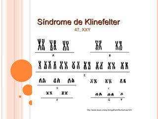 Síndrome de Klinefelter http://www.assis.unesp.br/egalhard/Numericas.htm 47, XXY 