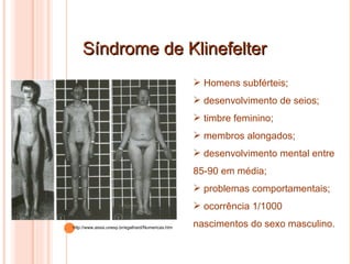 Síndrome de Klinefelter Homens subférteis; desenvolvimento de seios; timbre feminino; membros alongados; desenvolvimento mental entre 85-90 em média; problemas comportamentais; ocorrência 1/1000 nascimentos do sexo masculino.  http://www.assis.unesp.br/egalhard/Numericas.htm 