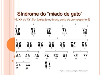 Síndrome do “miado de gato” http://www.assis.unesp.br/egalhard/Estruturais.htm 46, XX ou XY, 5p- (deleção no braço curto do cromossomo 5) 