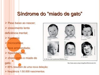 Síndrome do “miado de gato” http://www.assis.unesp.br/egalhard/Estruturais.htm Peso baixo ao nascer; crescimento lento deficiência mental; hipotonia; microcefalia; face arredondada; hipertelorismo; choro como o miado do gato; 85% resultam de uma nova deleção; freqüência 1:50.000 nascimentos. 