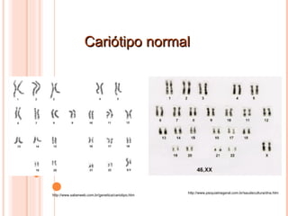 Elaboração Prof. Viviane Ferreira Cariótipo normal http://www.saberweb.com.br/genetica/cariotipo.htm http://www.psiquiatriageral.com.br/saudecultura/dna.htm 