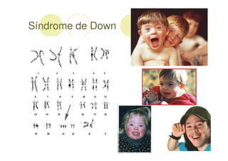 Síndrome de Down
 