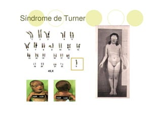 Síndrome de Turner
 