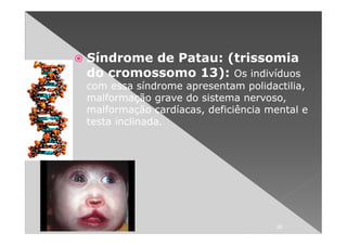 Síndrome de Patau: (trissomia
do cromossomo 13): Os indivíduos
com essa síndrome apresentam polidactilia,
malformação grave do sistema nervoso,
malformação cardíacas, deficiência mental e
testa inclinada.




                                    20
 