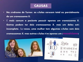CAUSAS
• Na síndrome de Turner, as células carecem total ou parcialmente
  de um cromossoma X;
• É mais comum a paciente possuir apenas um cromossoma X.
  Outras podem ter dois cromossomas X, mas um deles está
  incompleto. Às vezes, uma mulher tem algumas células com dois

  cromossomas X, mas outras células têm apenas um (mosaicismo)
 