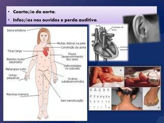 • Coartação da aorta;
• Infecções nos ouvidos e perda auditiva.
 