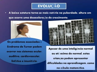 EVOLUÇÃO
• A baixa estatura torna-se mais notória na puberdade, altura em
  que ocorre uma desaceleração do crescimento.




 Os problemas associados à
 Síndrome de Turner podem
                                 Apesar de uma inteligência normal
 ocorrer nos sistemas ocular,
                                    ou até acima do normal, estas
  auditivo, cardiovascular,
                                     crianças podem apresentar
    linfático e imunitário.
                                 dificuldades na aprendizagem, como
                                       no cálculo matemático.
 