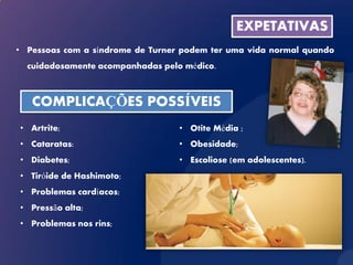 EXPETATIVAS
• Pessoas com a síndrome de Turner podem ter uma vida normal quando
  cuidadosamente acompanhadas pelo médico.



   COMPLICAÇÕES POSSÍVEIS
• Artrite;                        • Otite Média ;
• Cataratas:                      • Obesidade;
• Diabetes;                       • Escoliose (em adolescentes).
• Tiróide de Hashimoto;
• Problemas cardíacos;
• Pressão alta;
• Problemas nos rins;
 