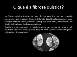 O que é a fibrose quística?
A fibrose quística trata-se de uma doença genética rara, de evolução
progressiva, que se caracteriza pela disfunção das glândulas exócrinas, as de
secreção externa como glândulas sudoríparas, intestinais, pancreáticas, do
fígado, brônquios ou órgãos reprodutores.
Devido a uma anomalia no funcionamento das trocas de água e sal,
produzem secreções mais espessas do que o normal provocando obstruções a
vários níveis do organismo.
 