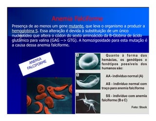 Anemia Falciforme
Presença de ao menos um gene mutante, que leva o organismo a produzir a
hemoglobina S. Essa alteração é devida à substituição de um único
nucleotídeo que altera o códon do sexto aminoácido da B-Globina de ácido
glutâmico para valina (GAG --> GTG). A homozigosidade para esta mutação é
a causa dessa anemia falciforme.
 