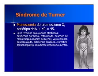 Síndrome de TurnerSíndrome de Turner
MonossomiaMonossomia do cromossomo X,do cromossomo X,
cariótipo 44A + X0 = 45.cariótipo 44A + X0 = 45.
Sexo feminino com ovários atrofiados,Sexo feminino com ovários atrofiados,
deficiência hormonal, esterilidade, ausência dedeficiência hormonal, esterilidade, ausência de
menstruação, mamas pequenas, vulva infantil,menstruação, mamas pequenas, vulva infantil,menstruação, mamas pequenas, vulva infantil,menstruação, mamas pequenas, vulva infantil,
pescoço alado, deficiência cardíaca, cromatinapescoço alado, deficiência cardíaca, cromatina
sexual negativa, raramente deficiência mental.sexual negativa, raramente deficiência mental.
 