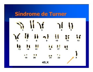 Síndrome de TurnerSíndrome de Turner
 