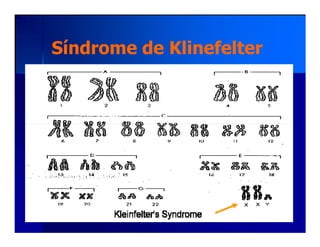 Síndrome de KlinefelterSíndrome de Klinefelter
 