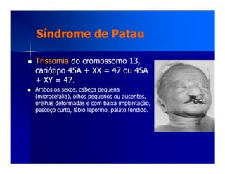 Síndrome deSíndrome de PatauPatau
TrissomiaTrissomia do cromossomo 13,do cromossomo 13,
cariótipo 45A + XX = 47 ou 45Acariótipo 45A + XX = 47 ou 45A
+ XY = 47.+ XY = 47.
Ambos os sexos, cabeça pequenaAmbos os sexos, cabeça pequenaAmbos os sexos, cabeça pequenaAmbos os sexos, cabeça pequena
(microcefalia), olhos pequenos ou ausentes,(microcefalia), olhos pequenos ou ausentes,
orelhas deformadas e com baixa implantação,orelhas deformadas e com baixa implantação,
pescoço curto, lábio leporino, palato fendido.pescoço curto, lábio leporino, palato fendido.
 