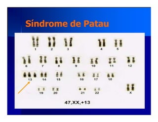 Síndrome de PatauSíndrome de Patau
 