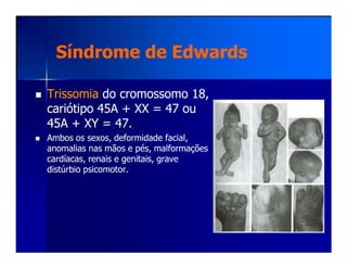 Síndrome de EdwardsSíndrome de Edwards
TrissomiaTrissomia do cromossomo 18,do cromossomo 18,
cariótipo 45A + XX = 47 oucariótipo 45A + XX = 47 ou
45A + XY = 47.45A + XY = 47.
Ambos os sexos, deformidade facial,Ambos os sexos, deformidade facial,Ambos os sexos, deformidade facial,Ambos os sexos, deformidade facial,
anomalias nas mãos e pés, malformaçõesanomalias nas mãos e pés, malformações
cardíacas, renais e genitais, gravecardíacas, renais e genitais, grave
distúrbio psicomotor.distúrbio psicomotor.
 