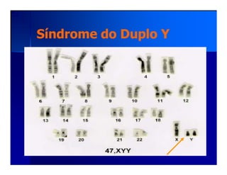 Síndrome do Duplo YSíndrome do Duplo Y
 