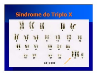 Síndrome do Triplo XSíndrome do Triplo X
 