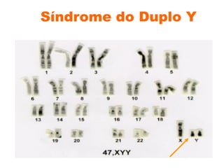 Síndrome do Duplo Y
 
