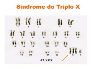 Síndrome do Triplo X
 