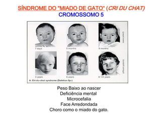 SÍNDROME DO "MIADO DE GATO“ (CRI DU CHAT)
CROMOSSOMO 5
Peso Baixo ao nascer
Deficiência mental
Microcefalia
Face Arredondada
Choro como o miado do gato.
 