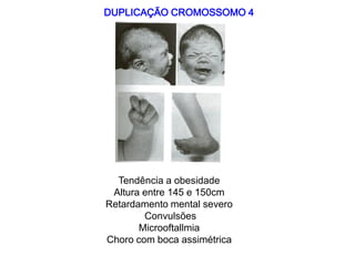 DUPLICAÇÃO CROMOSSOMO 4
Tendência a obesidade
Altura entre 145 e 150cm
Retardamento mental severo
Convulsões
Microoftallmia
Choro com boca assimétrica
 
