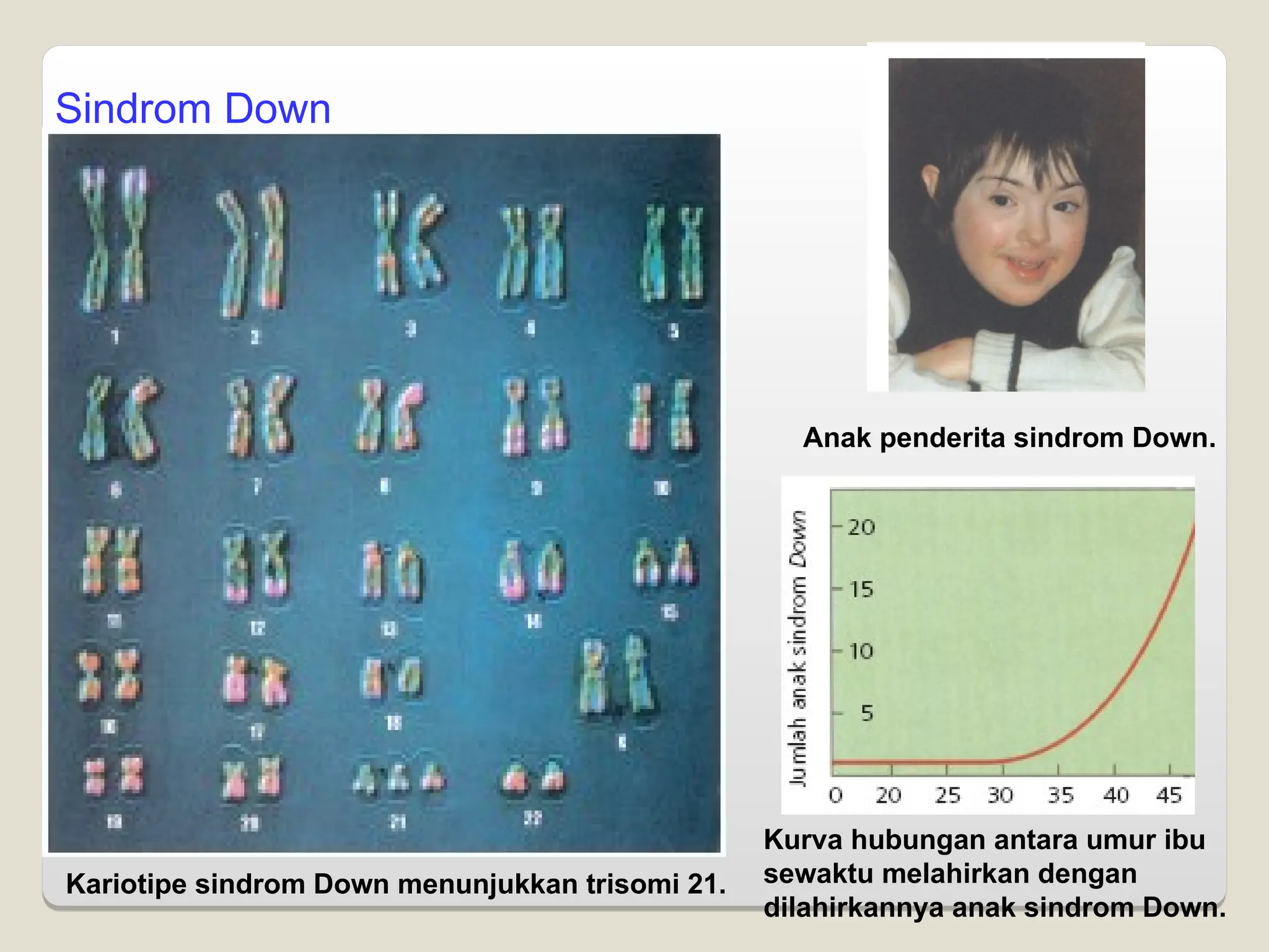Sindrom Down
Kariotipe sindrom Down menunjukkan trisomi 21.
Anak penderita sindrom Down.
Kurva hubungan antara umur ibu
sewaktu melahirkan dengan
dilahirkannya anak sindrom Down.
 