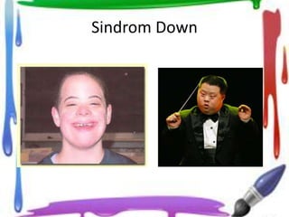 Sindrom Down
 