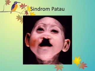 Sindrom Patau
 