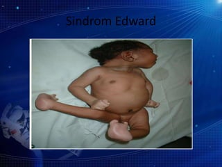 Sindrom Edward
 
