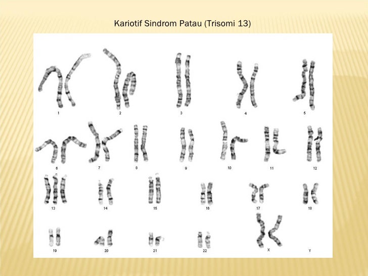 Mengapa Isokromosom Disebut Kebalikan Dari Translokasi