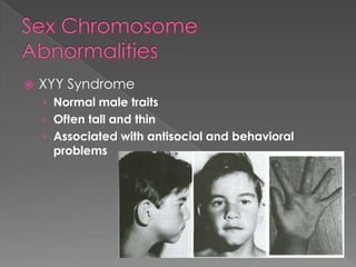 
XYY Syndrome
› Normal male traits
› Often tall and thin
› Associated with antisocial and behavioral
problems