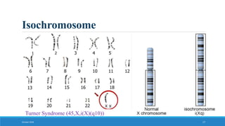 Isochromosome
October 2018 17
Turner Syndrome (45,X,i(X)(q10))
 