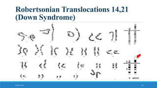 Robertsonian Translocations 14,21
(Down Syndrome)
October 2018 24
 