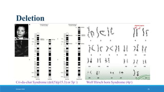 Deletion
October 2018 25
Cri-du-chat Syndrome (del(5)(p15.3) or 5p- ) Wolf Hirsch horn Syndrome (4p-)
 