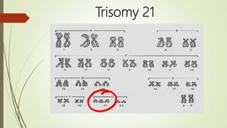 Trisomy 21
 