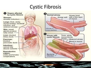 Cystic Fibrosis
 