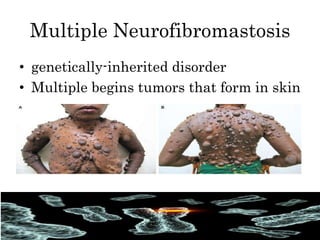 Multiple Neurofibromastosis
• genetically-inherited disorder
• Multiple begins tumors that form in skin
 