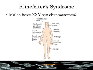 Klinefelter’s Syndrome
• Males have XXY sex chromosomes:
 