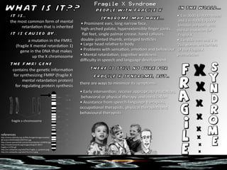 Fragile X Syndrome
 