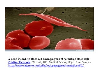 A sickle-shaped red blood cell among a group of normal red blood cells.
Creative Commons EM Unit, UCL Medical School, Royal Free Campus,
https://www.nature.com/scitable/topicpage/genetic-mutation-441/
 