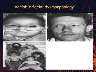 Variable facial dysmorphology
 