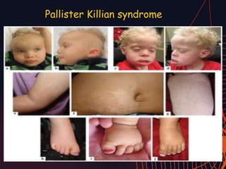 Pallister Killian syndrome
 