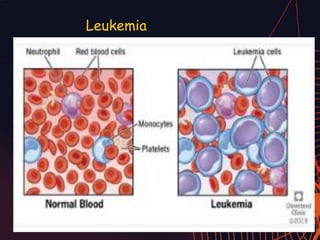 Leukemia
 